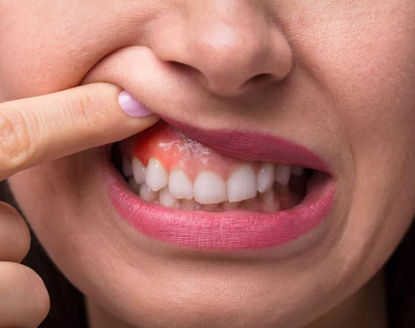 Что такое рак зуба