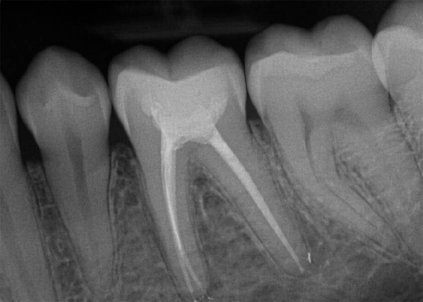 Показания и противопоказания к прицельному снимку зуба