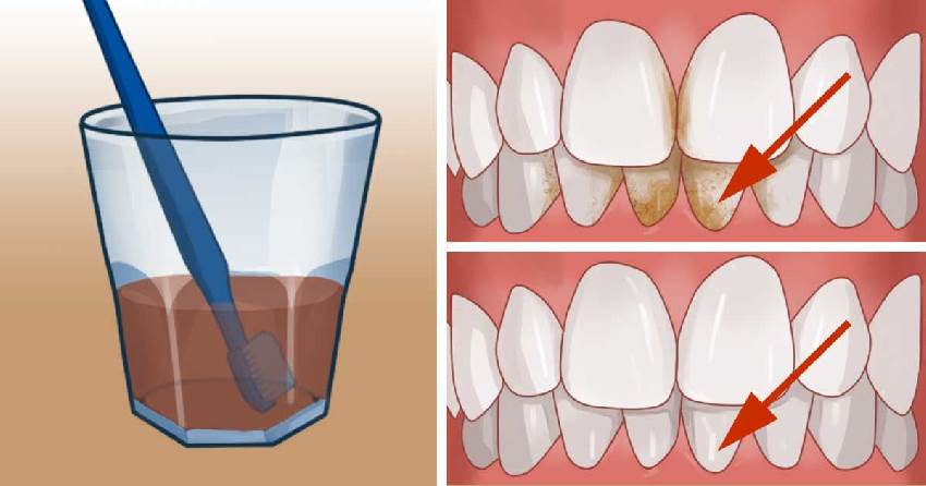 Диагностика и лечение зубной бляшки