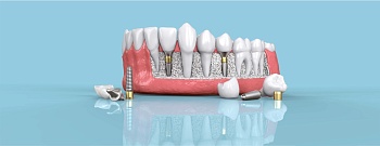 Зубные импланты: как выбрать из многообразия производителей?